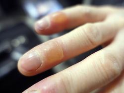 23 01 2016 aekaeskero lappland finnland erfrierung blasen an fingern einer hand 00s160123d456