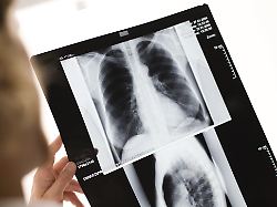 maennlicher arzt betrachtet roentgenbild lungenkrebs modellfreigabe vorhanden