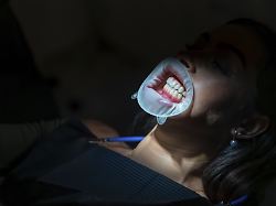 patientin die mit einem retraktor und einer led lampe in einem professionellen zahnaerztlichen umfeld eine zahnaufhellungsbehandlung erhaelt modellfreigabe vorhanden