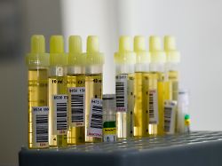 roehrchen mit gelbem urin gefuellt in einem grauen gestell sortiert bereit fuer die diagnose