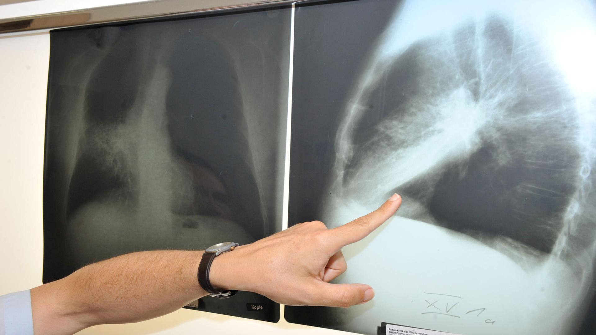 roentgenbild lungenkrebs 100