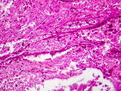 purulent meningitis light micrograph photo under microscope