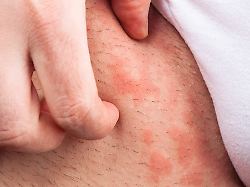 kratzen jucken juckreiz nesselfieber scratching itching 1un h77