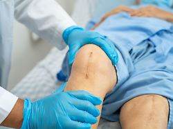 asian senior or elderly old lady woman patient show her scars surgical total knee joint replacement suture wound surgery arthroplasty on bed in nursing hospital ward healthy strong medical concept