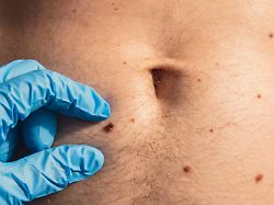 dermatologist checking male birthmarks doctor in medical gloves examining man skin mole self care preventing cancer procedure protection treatment