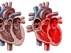 broken heart syndrome or takotsubo cardiomyopathy with a healthy organ anatomy cross section concept of an inner cardiovascular organ