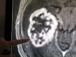 in der diagnostik der radiologie der universitaetsmedizin rostock wird mit hilfe der magnetresonanztomographie ein tumor festgestellt
