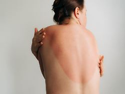 view of the sunburned skin of a woman s back