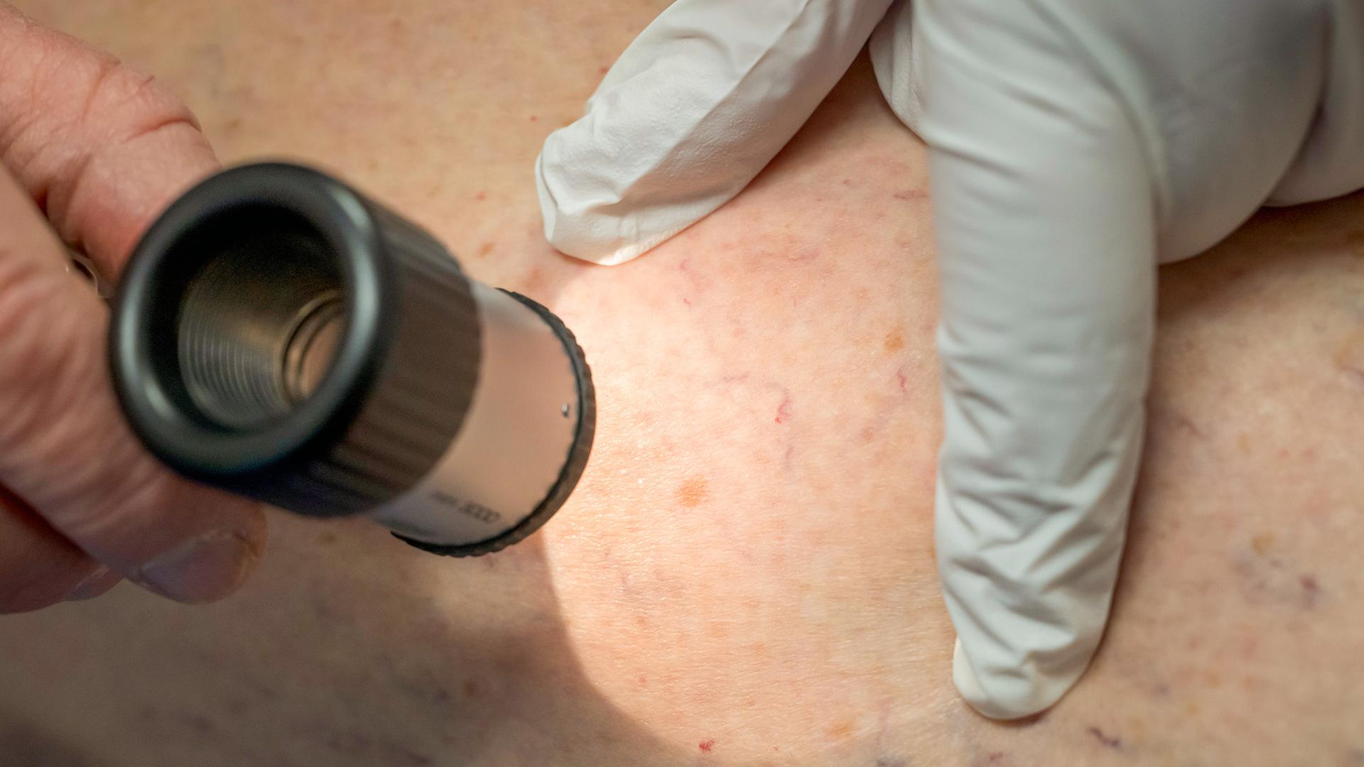 hautkrebs screening 112